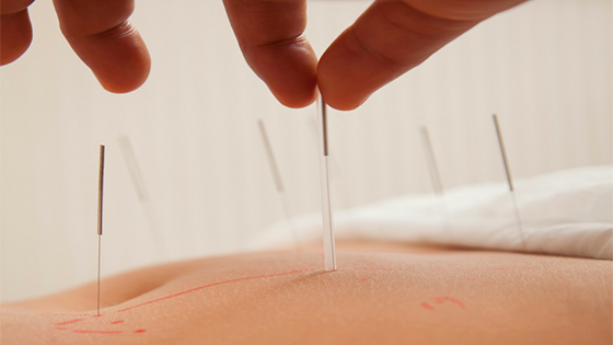 Acupuncture: Potential Medications for Treating Inflammation& Pain