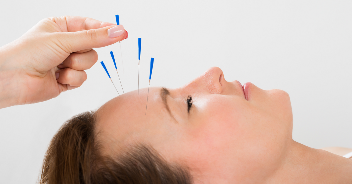 Acupuncture Therapy