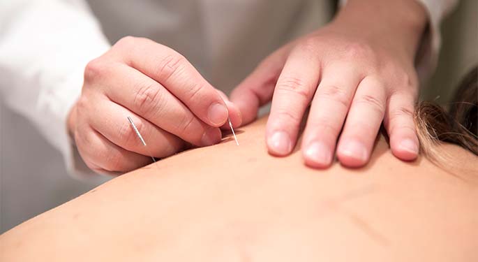 Acupuncture in Cancer Care